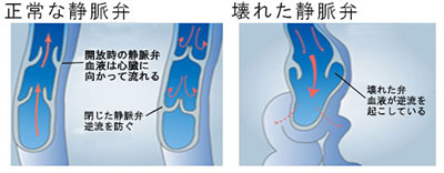 下肢静脈瘤ができる理由